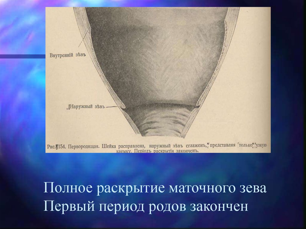 Раскрытие. Степень раскрытия маточного зева. Полное раскрытие маточного зева. Полное раскрытие шейки матки.