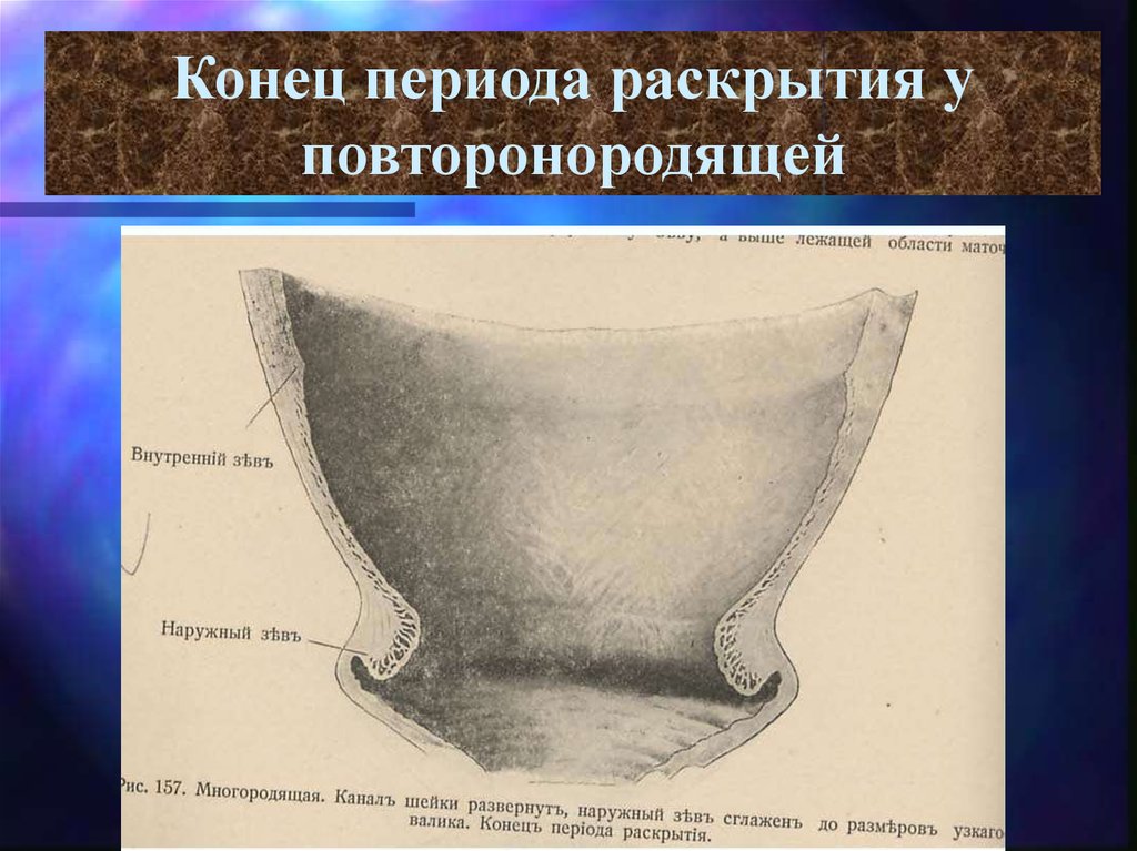 Конец периода. Окончание периода. Течение периода раскрытия видеору.