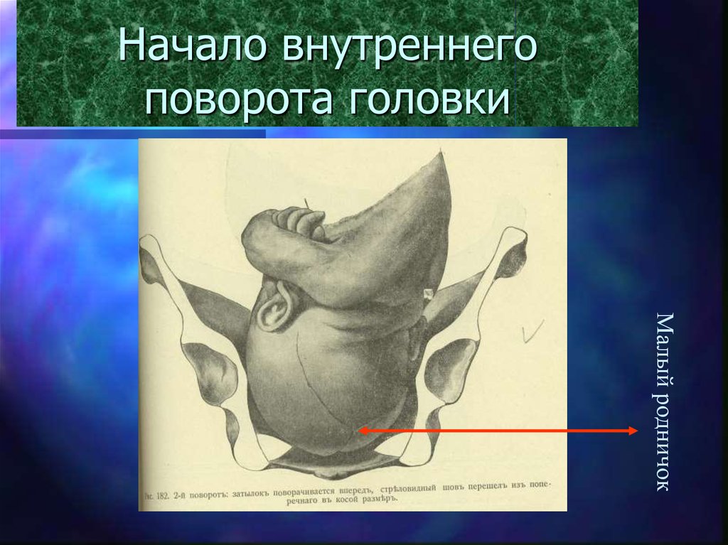 Внутреннее начало. Внутренний поворот головки. Крестцовая ротация. Крестцовая ротация головки. Внутренний поворот головки происходит.