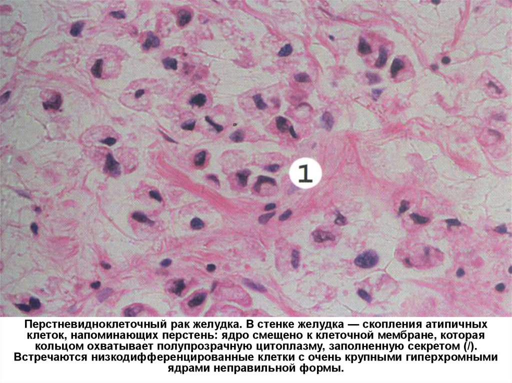 Раковые клетки желудка. Перстневидноклеточная аденокарцинома. Гидропическая дистрофия эпителия извитых канальцев. Перстневидноклеточная аденокарцинома желудка. Гидропическая дистрофия почки.