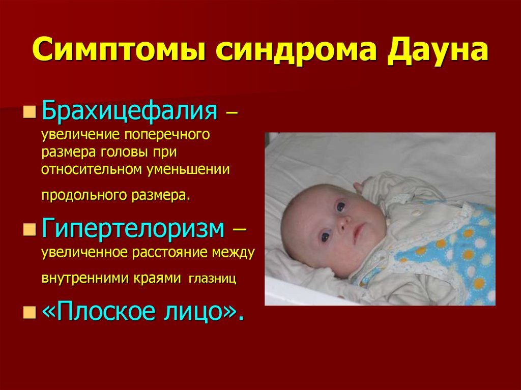 Какие есть синдромы дауна. Синдром Дауна у детей симптомы. Признаки Дауна у новорожденного ребенка. Симптомы синдрома Дауна у новорожденных.