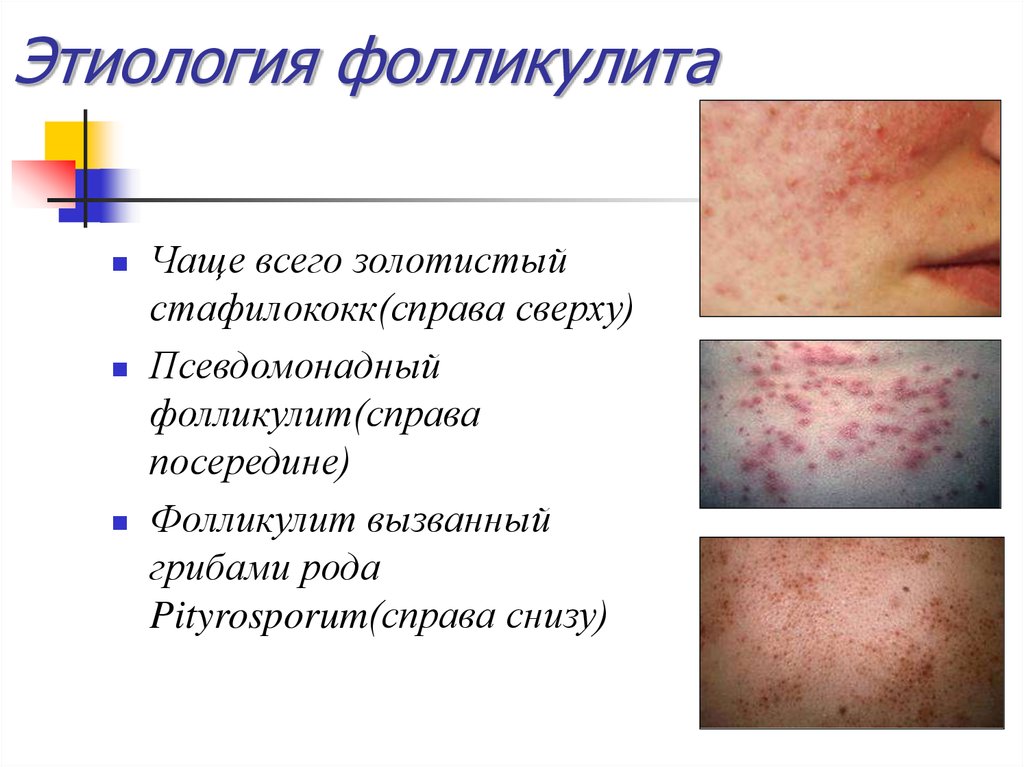 Гнойные заболевания глубоких клетчаточных пространств и железистых органов презентация