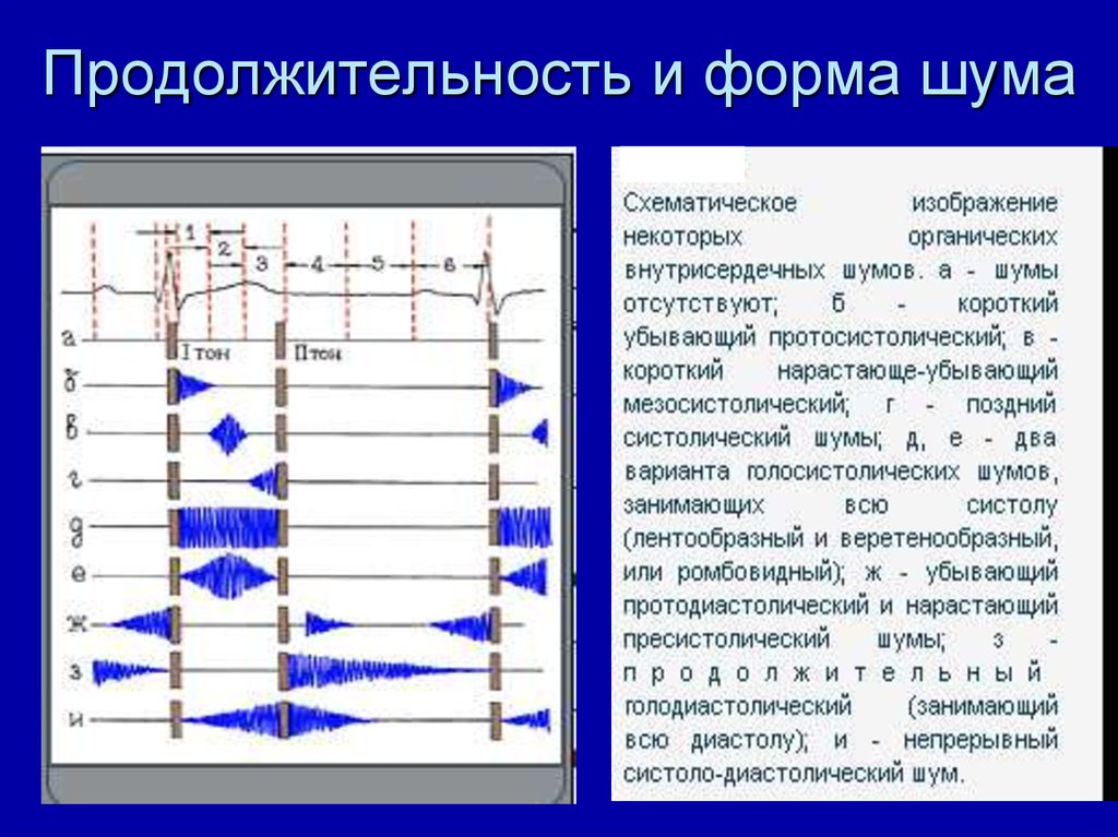 Шумы сердца пропедевтика презентация