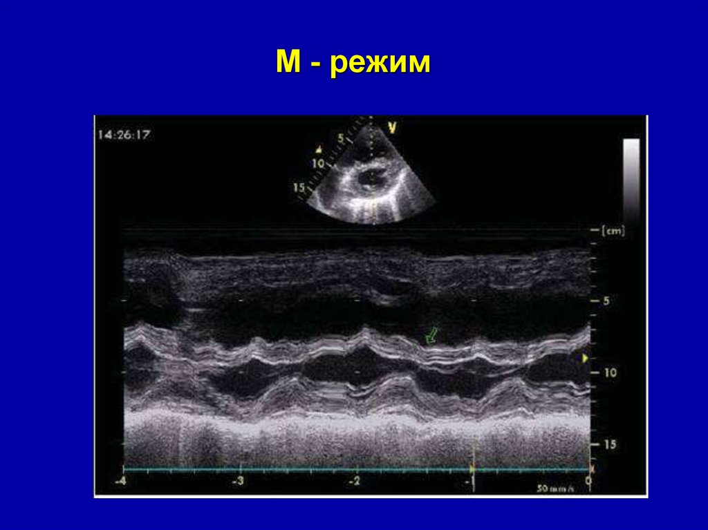 М режим. Парадоксальное движение межжелудочковой перегородки. Парадоксальное движение межжелудочковой перегородки УЗИ. Парадоксальное движение МЖП. Парадоксальное движение перегородки на эхокардиографии.