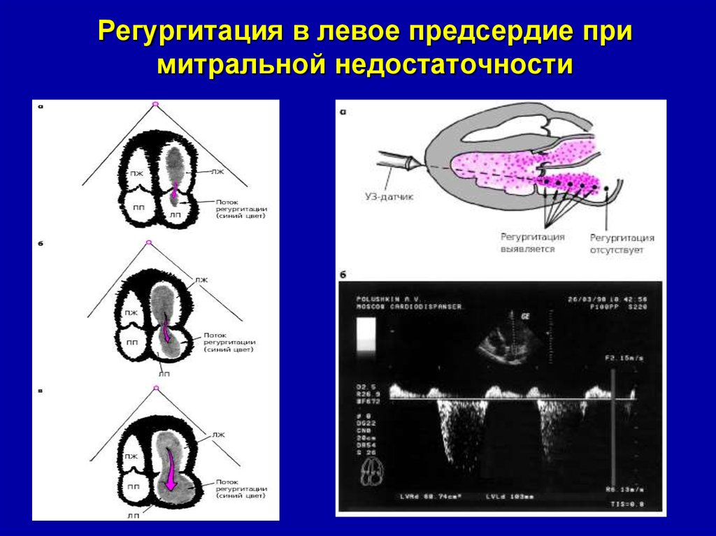 Недостаточность предсердия. Фракция регургитации митрального клапана. Степени митральной недостаточности по ЭХОКГ. ЭХОКГ оценка митральной недостаточности. Фракция регургитации при митральной недостаточности.