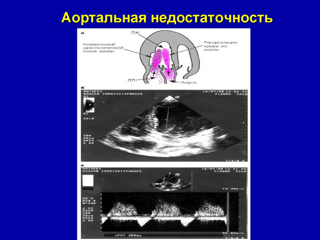 Степень регургитации предсердий. Аортальная недостаточность ЭХОКГ. Митральная недостаточность УЗИ. Аортальная регургитация на ЭХОКГ. Эхо кг аортальная недостаточность.