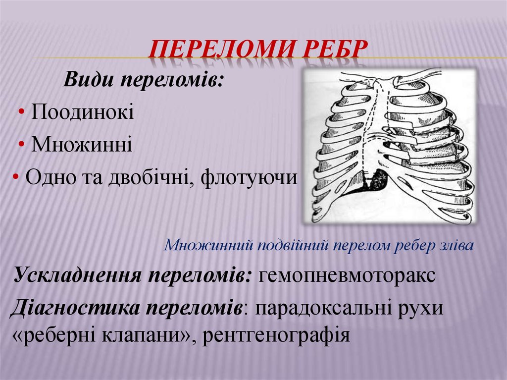 Переломы ребер презентация