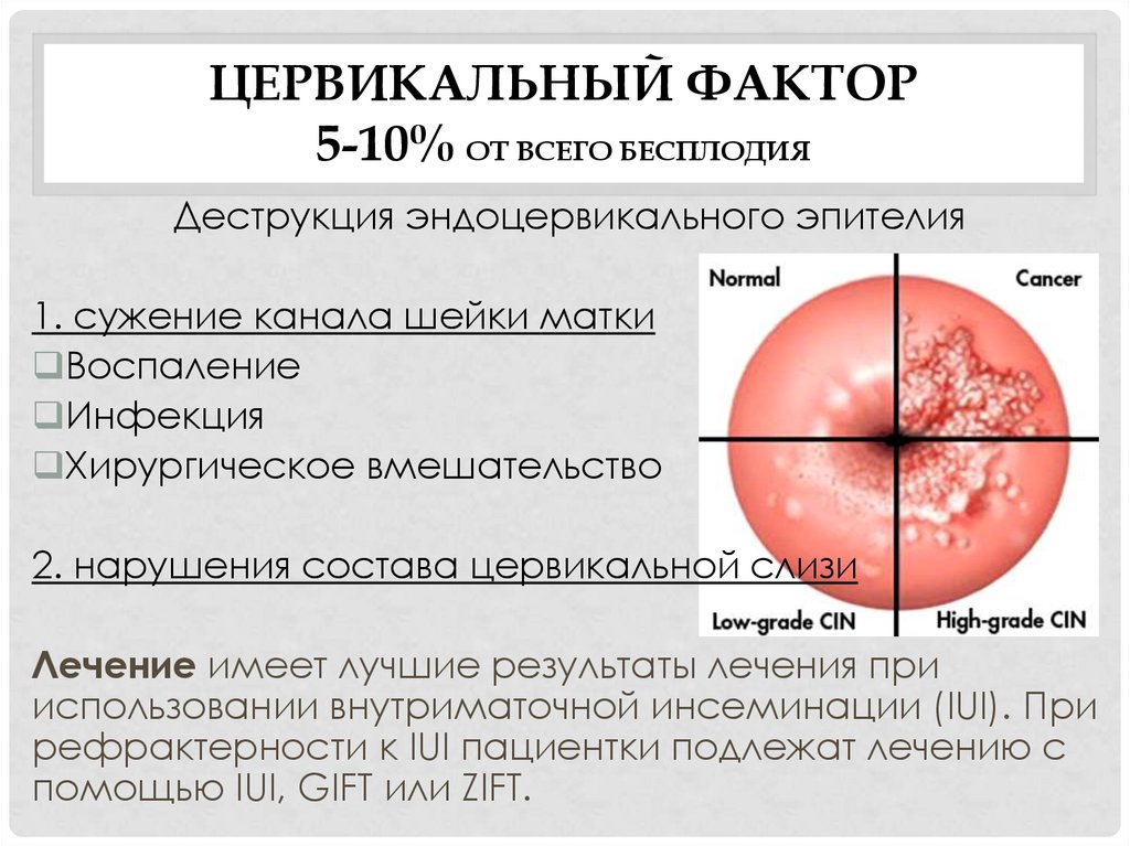 Цервикальный канал в менопаузе