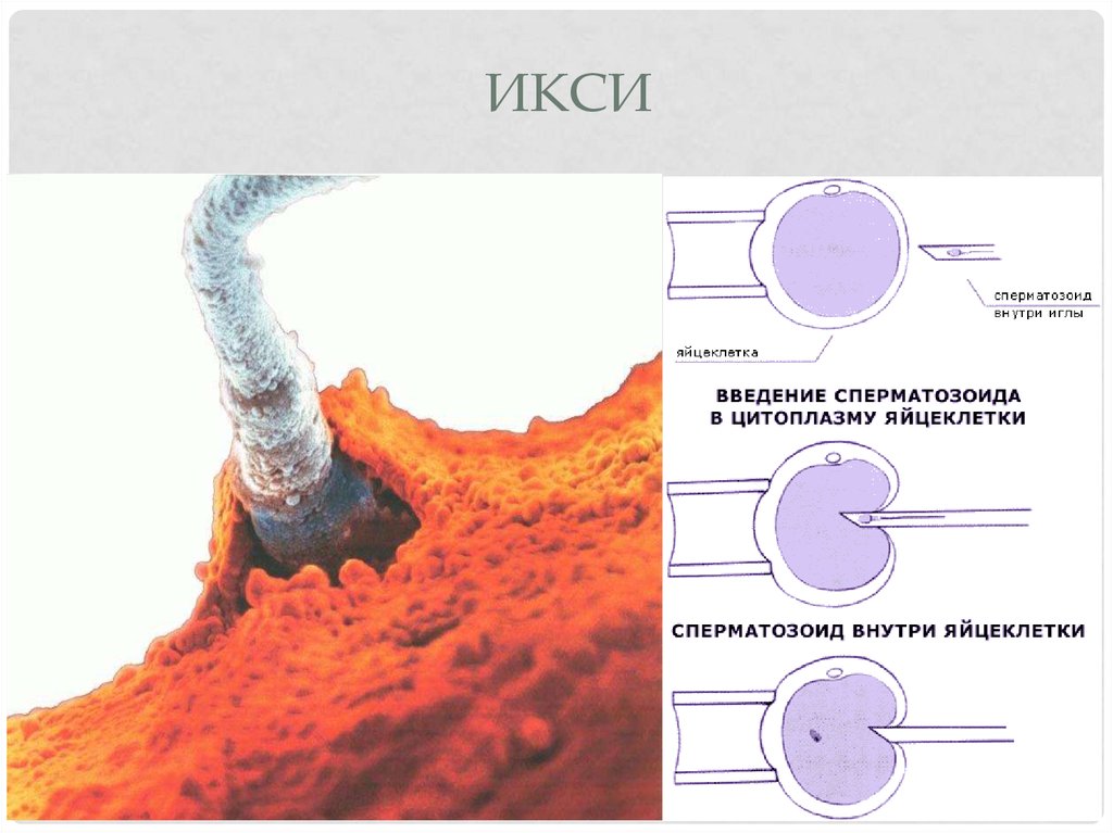 Затем происходит. Инъекция сперматозоида в цитоплазму ооцита (ИКСИ). Методика ИКСИ. Введение сперматозоида в ооцит. Оплодотворение методом ИКСИ что это.