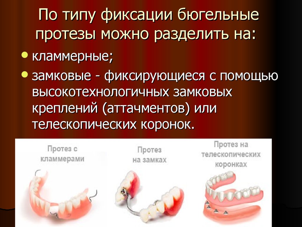 Виды протезов. Фиксирующие элементы бюгельного протеза. Способы фиксации бюгельный протез. Классификация замковых креплений бюгельных протезов. Типы крепления замковые крепления бюгельных протезов.