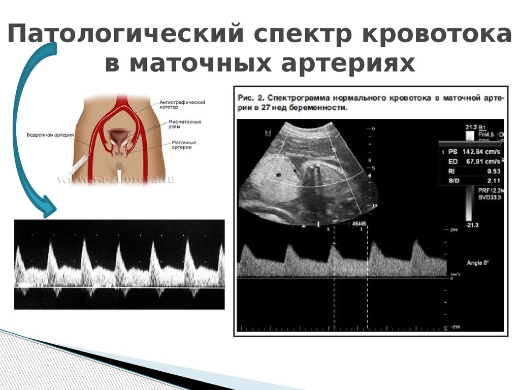 Маточная гемодинамика. Нарушение кровотока в маточных артериях при беременности. Кровоток в маточных артериях при беременности. Нарушение кровотока в маточной артерии. Кроанток в матосных артеричх.