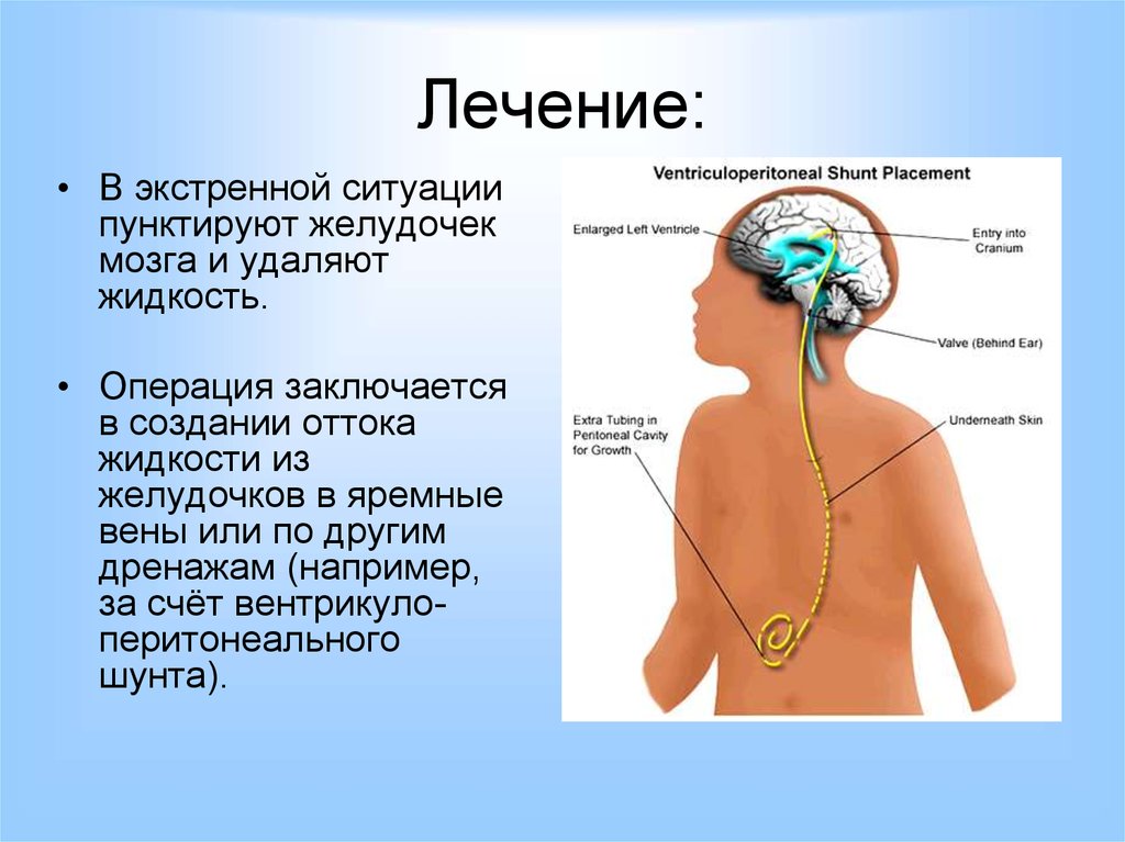 Шунт головного мозга. Вентрикуло-перитонеальное шунтирование головного мозга. Шунтирование желудочков мозга. Вентрикулоперикардиальное шунтирование.