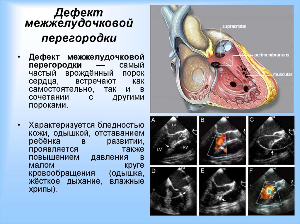 Дмжп у плода