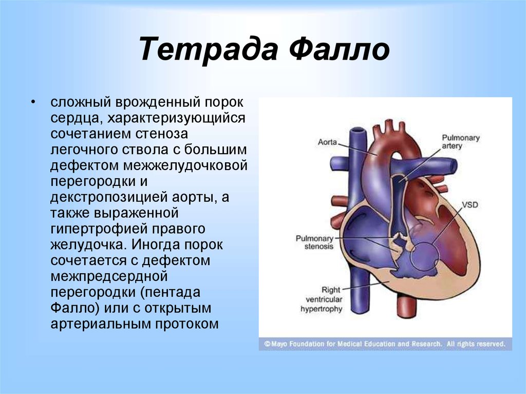 Порок что это. Врожденный порок сердца Тетрада Фалло у детей. Тетрада Фалло это врожденный порок сердца. Врождённый порок сердца синего типа Тетрада Фалло. Радикальная операция Тетрада Фалло.