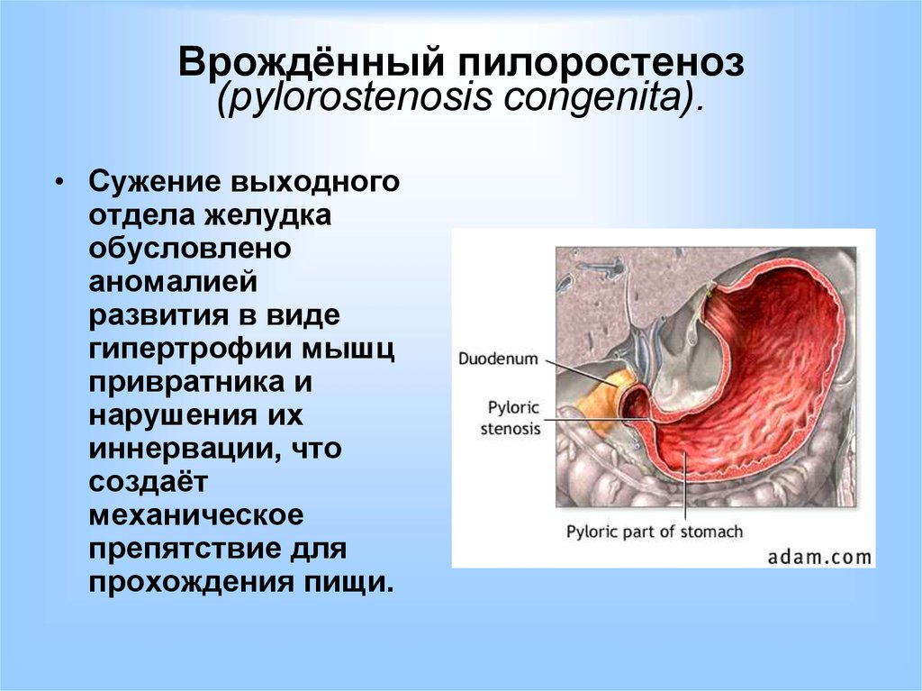 Пилоростеноз врожденный презентация