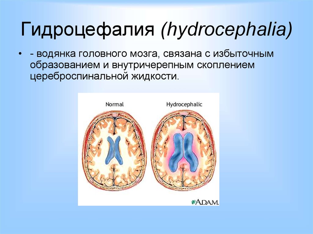 Неокклюзионная гидроцефалия. Внутренняя гидроцефалия головного. Внутренняя водянка головного мозга. Обтурационная гидроцефалия.