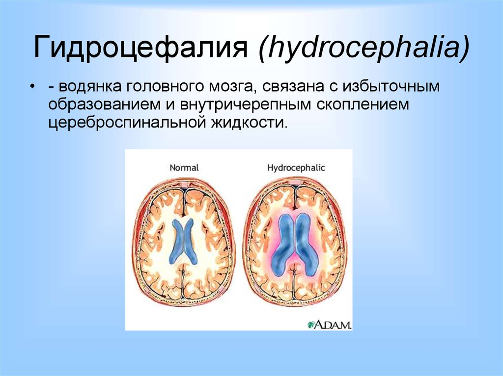 Выраженная наружная гидроцефалия