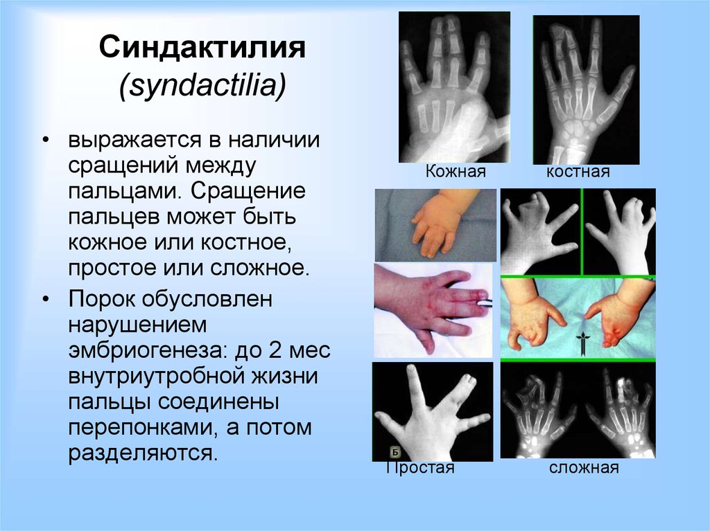 Перепонки между пальцами у мужчин. Костная форма синдактилии. Пороки развития кисти синдактилия. Синдактилия рентген описание. Симбрахидактилия левой кисти левой стопы.