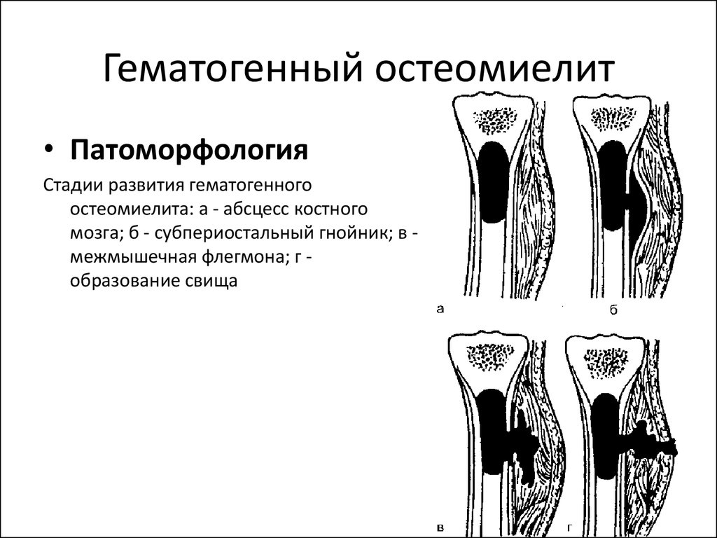 Гематогенный. Острый гематогенный остеомиелит схема. Фазы острого гематогенного остеомиелита. Формы острого гематогенного остеомиелита. Острая фаза гематогенного остеомиелита схема.