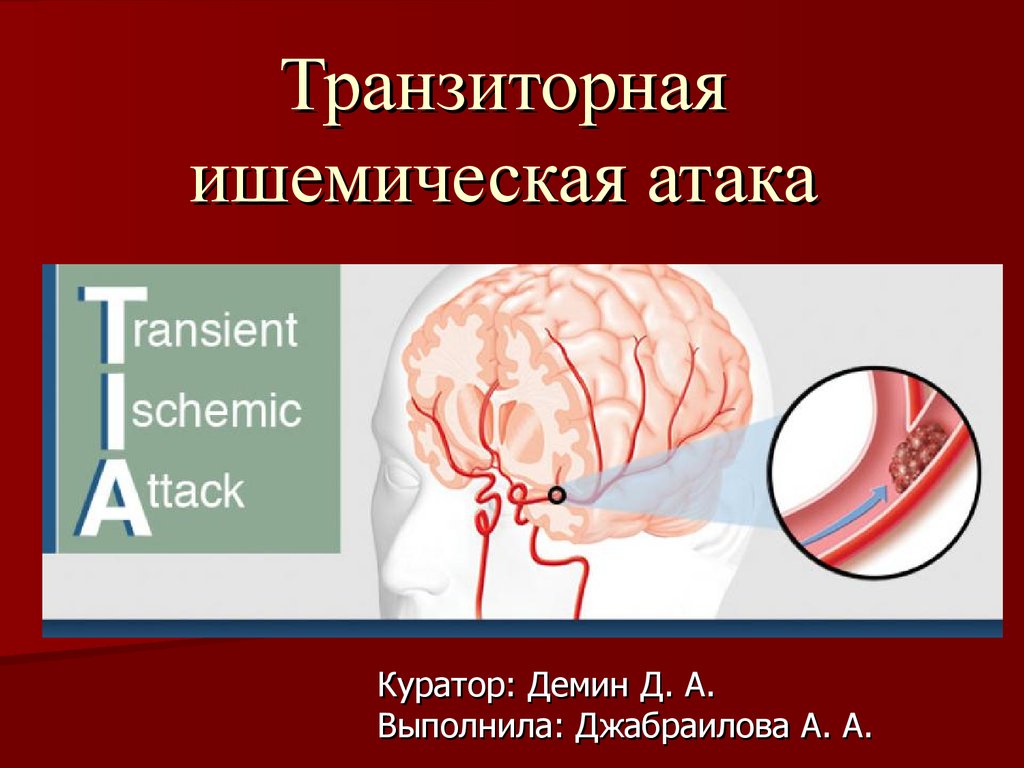 Транзиторная ишемическая атака презентация