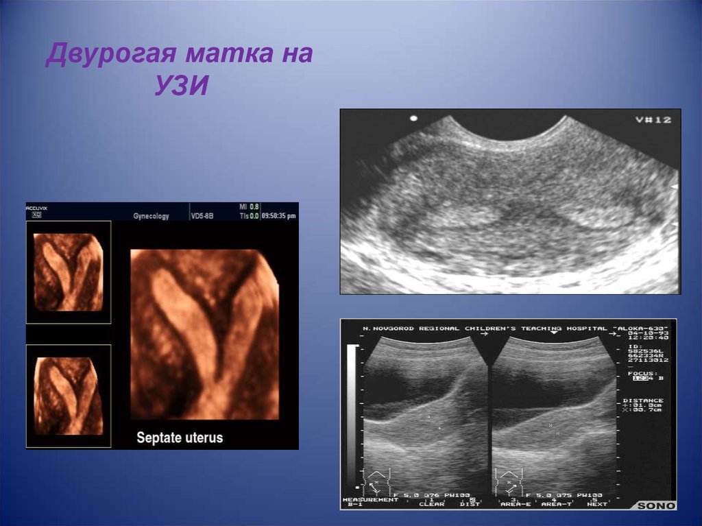 Двурогая матка форум. Двурогая седловидная матка. Двурогая матка и седловидная матка. Двурогая матка и беременность УЗИ.