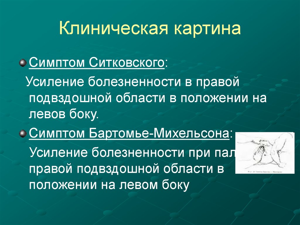 Бартомье михельсона. Симптом Ситковского наблюдается при. Bartome Mixaelson simptomi. Симптом Бартомье Михельсона.