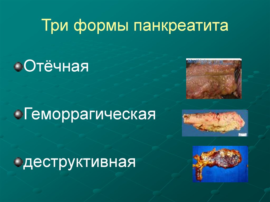 Отечный панкреатит. Формы острого панкреатита. Острый панкреатит отечная форма. Геморрагический панкреатит.