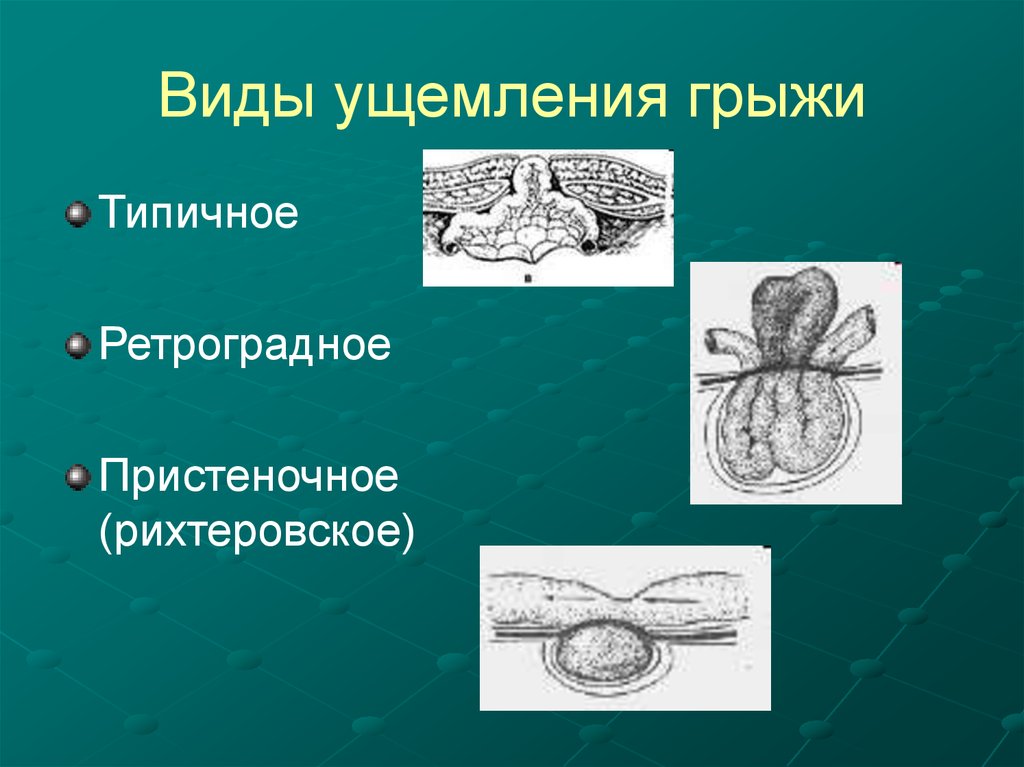 Ущемленная грыжа. Антеградное ущемление грыжи.