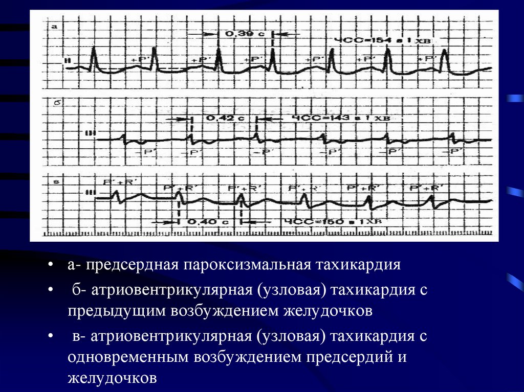 Презентация пароксизмальные тахикардии