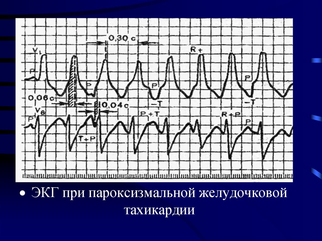 Желудочковая тахикардия картинки