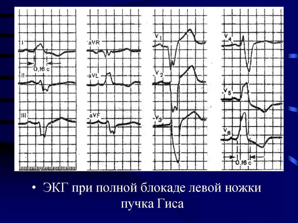 Левой ножки пучка. Блокада пучка Гиса на ЭКГ. Неполная блокада передней ветви левой ножки пучка Гиса. ЭКГ при полной блокаде левой ветви пучка Гиса. ЭКГ при полной блокаде ЛНПГ.