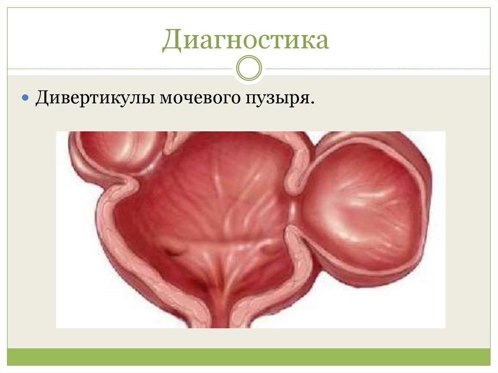 Дивертикул мочевого пузир. Ложный дивертикул мочевого пузыря. Псевдодивертикулы мочевого пузыря. Дивертикул мочевого пузыря. Дивертикул и псевдодивертикулы мочевого пузыря.