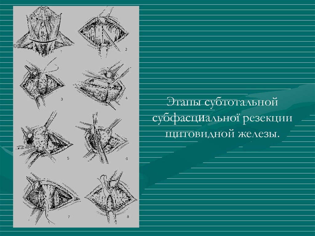 Резекция щитовидной железы. Субтотальная резекция щитовидной железы. Резекция щитовидной железы этапы. Субтотальная резекция щитовидной железы этапы. Субтотальная резекция щитовидной железы схема.