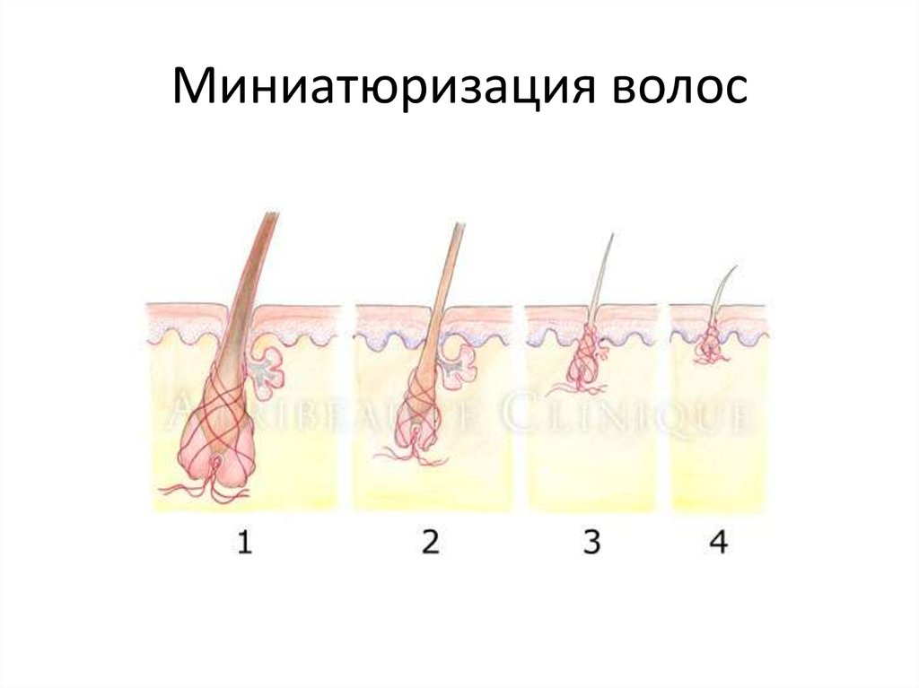 Миниатюризация волос