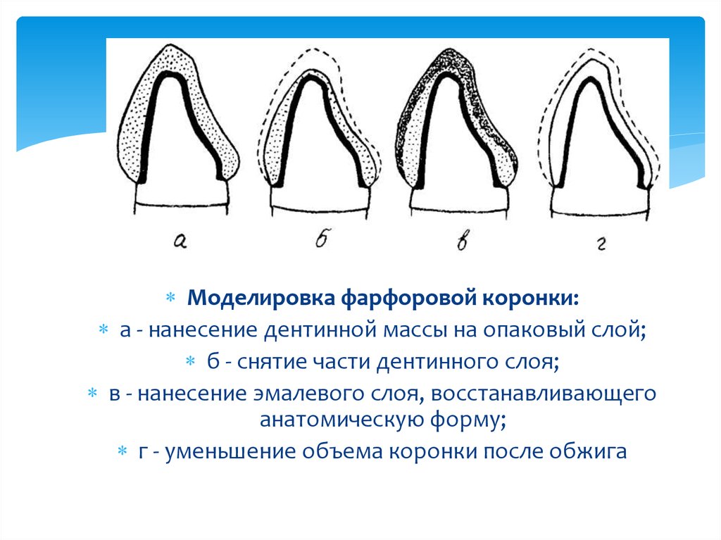 Коронка на передний зуб схема