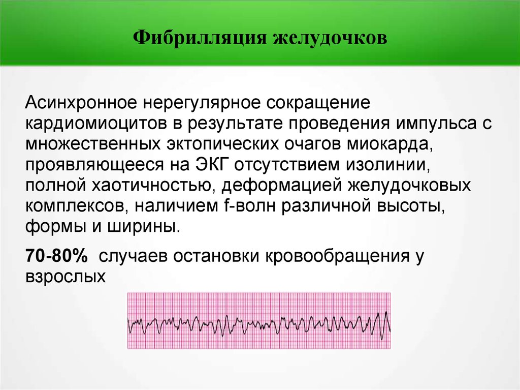 Как выглядит фибрилляция желудочков на мониторе