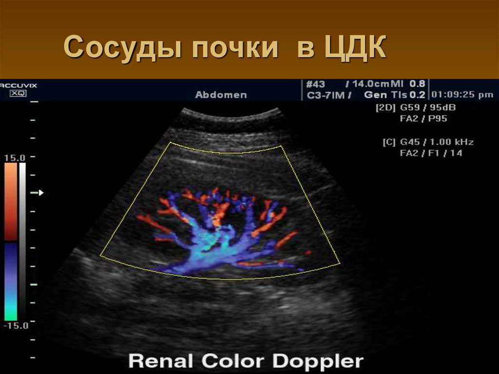 Доплер артерий. Допплер почечных артерий норма. УЗИ почек допплер сосудов почек. Цветовое допплеровское картирование почки. Дуплексное сканирование сосудов почек.