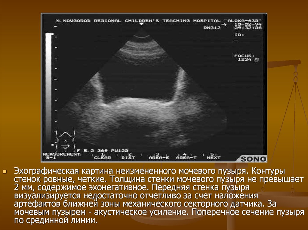 Характеристика эхонегативного изображения