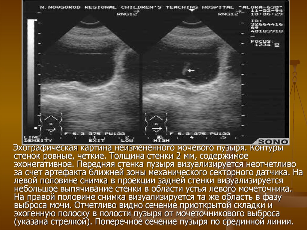 Узи моча мочевого пузыря. УЗИ нормального мочевого пузыря. Толщина стенки мочевого пузыря УЗИ. Измерение объема мочевого пузыря на УЗИ. УЗИ мочевого пузыря норма.