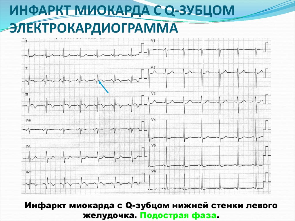 Инфаркт миокарда на экг фото