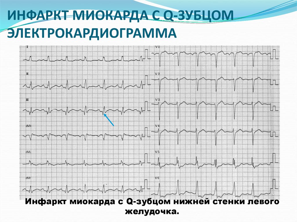 Передний боковой инфаркт миокарда