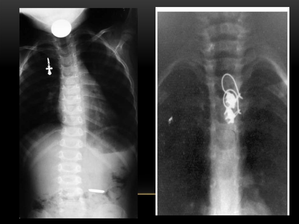 Инородное тело. Рентген инородное тело в ЖКТ. Инородное тело пищевода рентген. Инородные тела пищеварительного тракта рентген. Эзофагоскопия инородное тело пищевода.