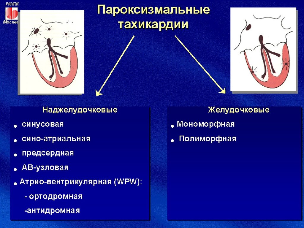 Пароксизмальная наджелудочковая тахикардия. Наджелудочковая и желудочковая пароксизмальная тахикардия. Пароксизмальная тахикардия патогенез. Желудочковая пароксизмальная тахикардия патогенез. Пароксизмальная антидромная тахикардия.