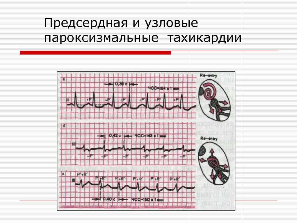 Предсердная тахикардия. Реципрокная предсердная тахикардия. Предсердная АВ пароксизмальная тахикардия. Предсердная Узловая тахикардия. Узловая пароксизмальная тахикардия.