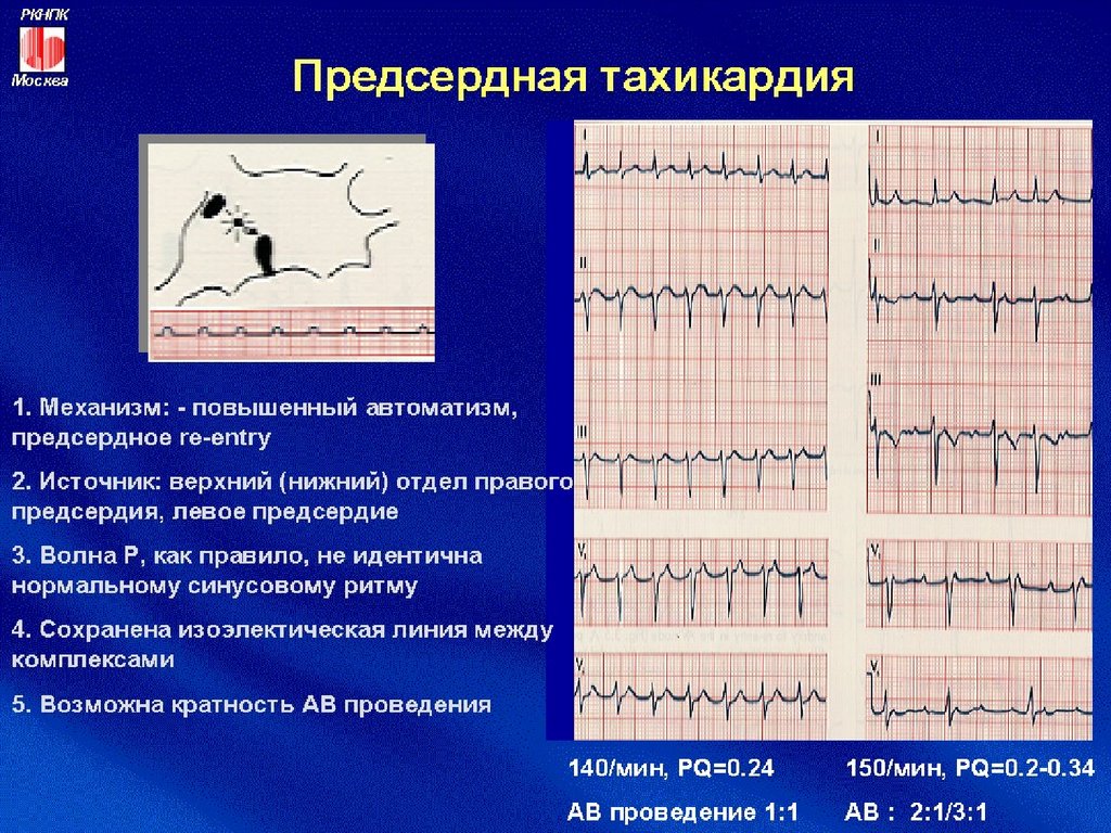 Предсердная тахикардия. Синусовая и предсердная тахикардия. Эктопическая предсердная тахикардия ЭКГ. Мультифокусная предсердная тахикардия.