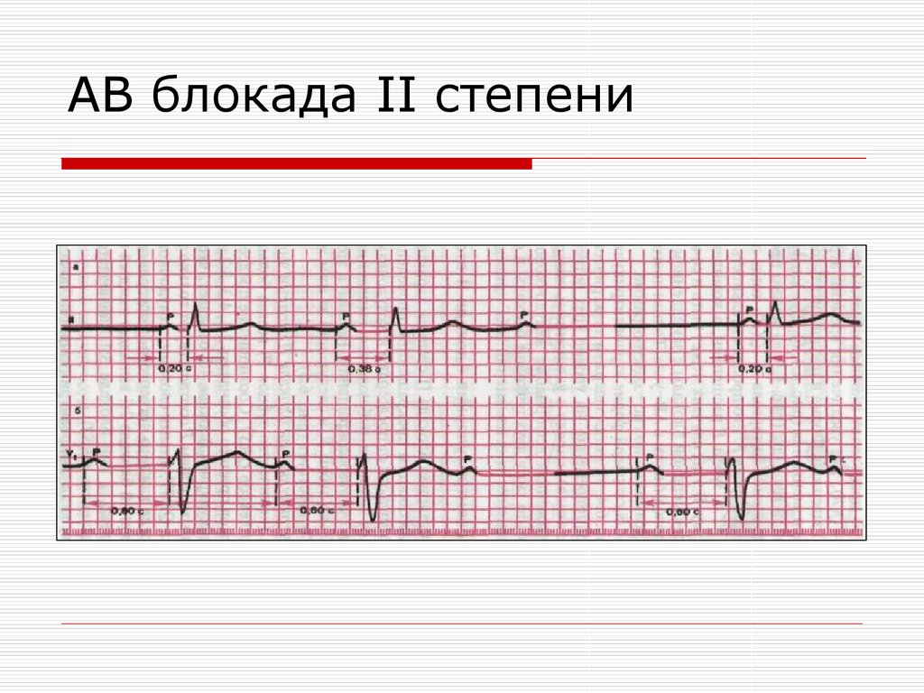 Ав блокада степени. АВ блокада 2 ст Мобитц 2 ЭКГ. Аб блокада 2 степени Мобиц 2. Неполная АВ блокада 2 степени 2 типа. АВ блокада 2 Тип Мобиц 2.