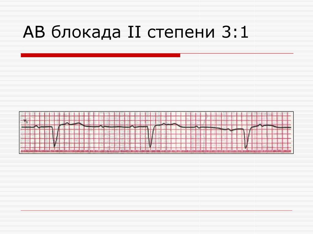 Ав блокада. АВ блокада 2 степени Мобиц 3. АВ блокада 3 степени проксимальный Тип. АВ-блокада 2 степени Мобитц 2 ,3:1. АВ блокада 1 2 3 степени на ЭКГ.