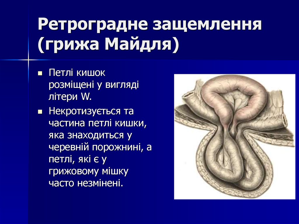 Какова клиническая картина при рихтеровском ущемлении