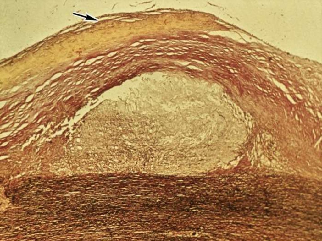 Картина фиброзных изменений. Атеросклероз аорты микропрепарат Судан 3. Атеросклероз аорты макропрепарат. Атеросклероз аорты микропрепарат. Макропрепарат атеросклероз аорты с аневризмой брюшного отдела.