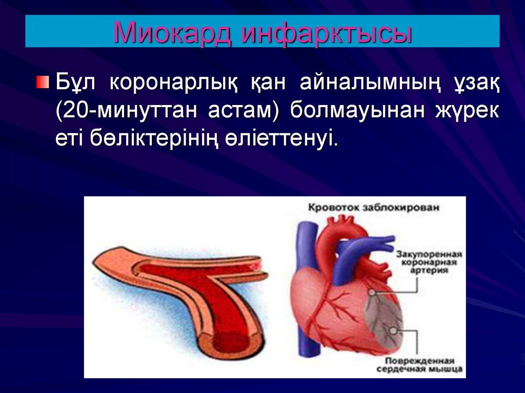 Миокард инфарктісі презентация